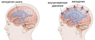 causes of intracranial pressure