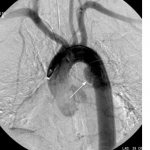 An example of aortography. The arrow indicates a saccular protrusion (aneurysm) 