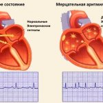 Прижигание сердца при мерцательной аритмии