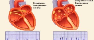 Прижигание сердца при мерцательной аритмии