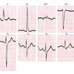 Sign of right ventricular hypertrophy