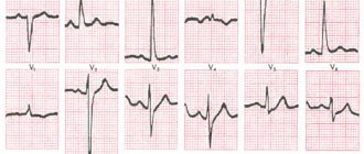 Sign of right ventricular hypertrophy