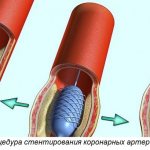 процедура стентирования коронарных артерий