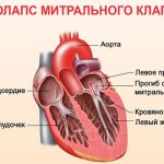 Mitral valve prolapse