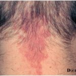 Simple capillary hemangioma