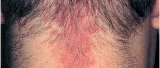 Simple capillary hemangioma