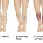 Manifestations of varicose veins