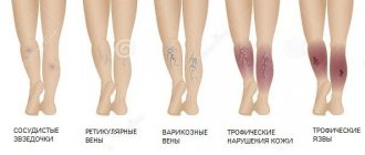 Manifestations of varicose veins