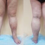 PTFB PTB leg swelling