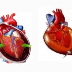 pericardial puncture