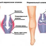 Valve function in chronic venous insufficiency