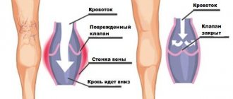 Valve function in chronic venous insufficiency