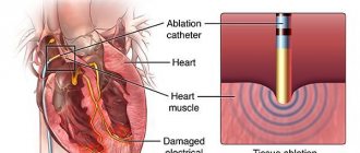 Radiofrequency ablation