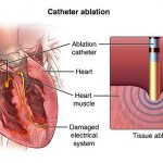 Радиочастотная аблация