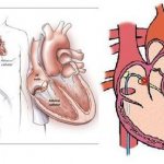 Radiofrequency ablation