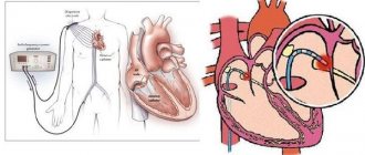 Radiofrequency ablation