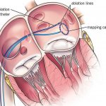 Radiofrequency ablation of arrhythmogenic foci