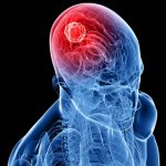 Brain cancer (Brain tumor)