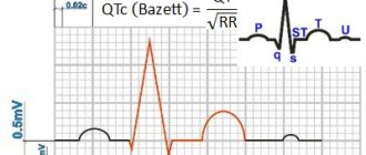 Calculation of corrected QT – Bazett&#39;s formula – QTc