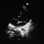 Interpretation of ultrasound of the heart
