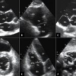 Interpretation of ultrasound of the heart in an adult