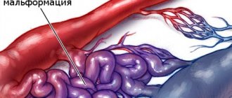 Expansion of connections between artery and vein leads to the development of malformation