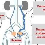 Dilatation of the ovarian vein