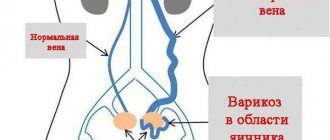 Dilatation of the ovarian vein