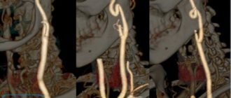 Various types of pathological tortuosity of the carotid arteries