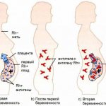 Rh conflict during re-pregnancy