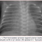 Rice. 1. X-ray of the chest organs (direct projection) on the 80th day of life. (From the archive of E.S. Truntsova) 