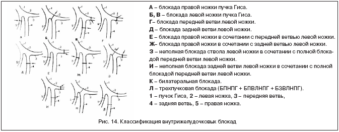 Полная блокада правой ножки пучка гиса карта вызова