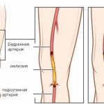 vascular bypass surgery of the lower extremities