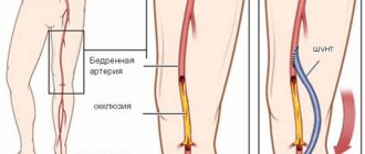 шунтирование сосудов нижних конечностей
