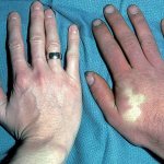 Symptoms of acrocyanosis