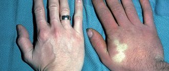 Symptoms of acrocyanosis