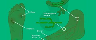 Симптомы диабетической стопы