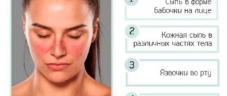 Lupus symptoms