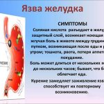 Symptoms of a stomach ulcer