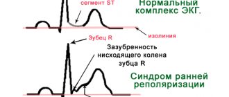 Early ventricular repolarization syndrome