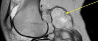 Synovial sarcoma of the knee joint