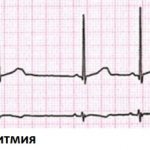 Sinus arrhythmia