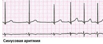 Sinus arrhythmia