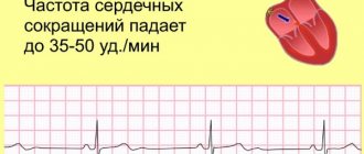 Синусовая брадиаритмия сердца у ребенка, подростка. Что это такое, занятия спортом