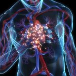 Склероз легких