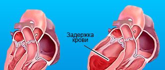 SLN