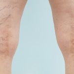 Spider veins on the legs