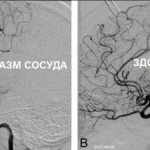 Cerebral vasospasm