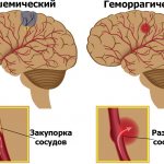 Experts distinguish two types of stroke - ischemic and hemorrhagic.