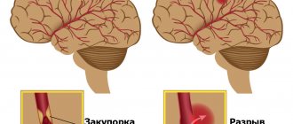 Специалисты выделяют два вида инсульта — ишемический и геморрагический